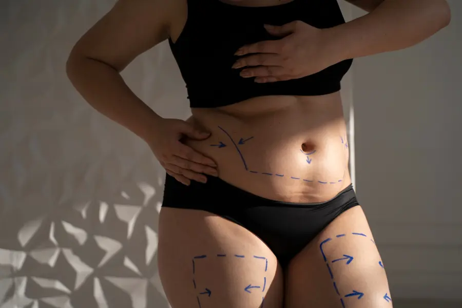 Post operatorio della liposuzione: come gestirlo?